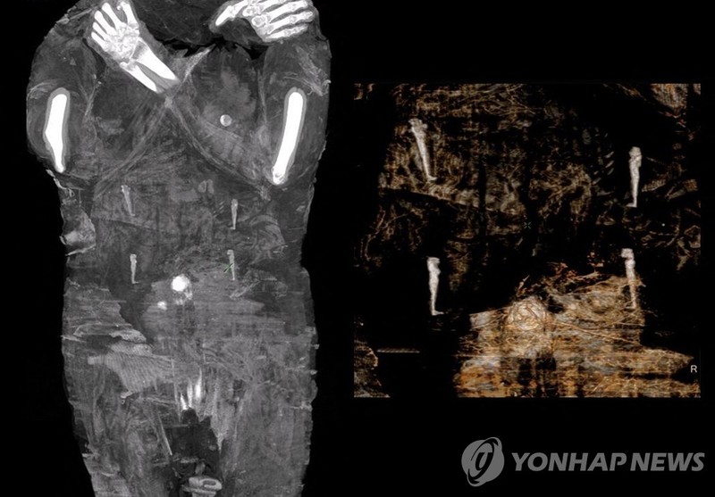 고대이집트 임신부 미라 최초 발견…태아 손발 포착