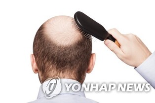 탈모, '중장년 남성'만의 고민 아냐…10명중 3명 탈모경험